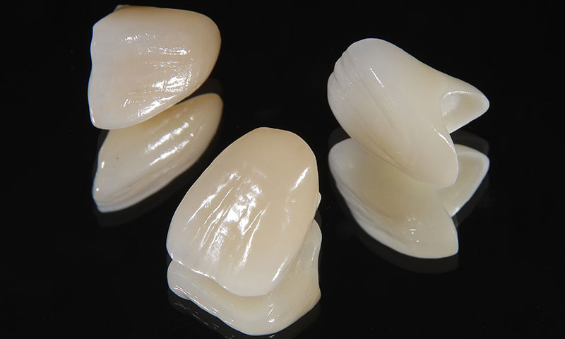 オールセラミッククラウン