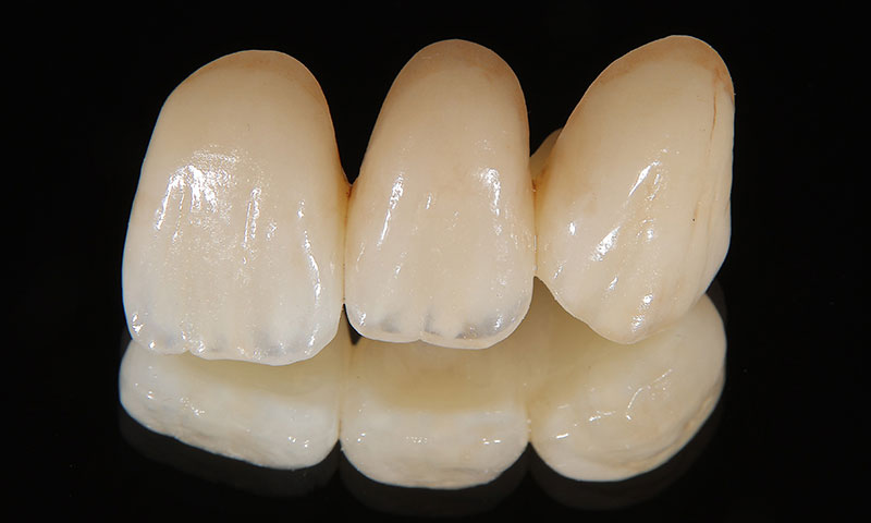 オールセラミック・ブリッジ