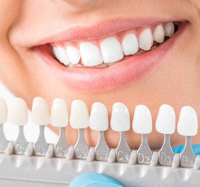 ホワイトニング