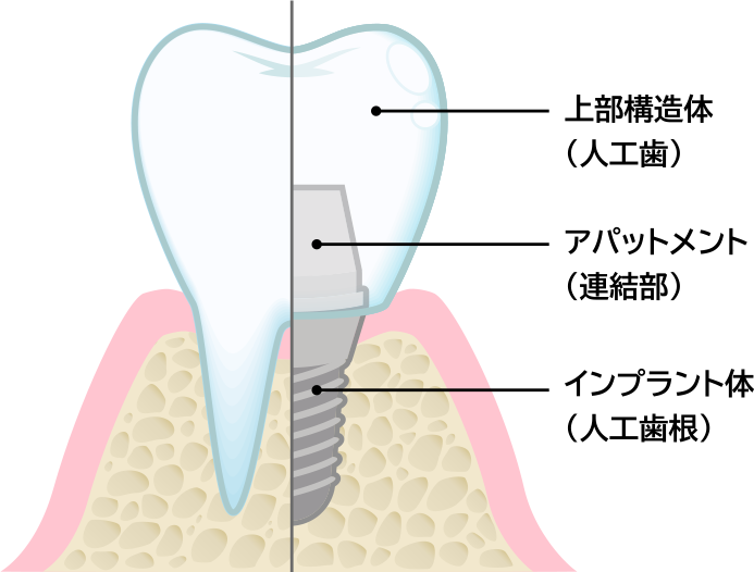 インプラント治療とは？