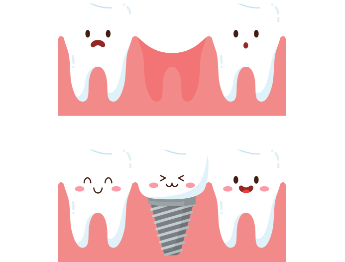 歯を失ったままにするとどうなる？