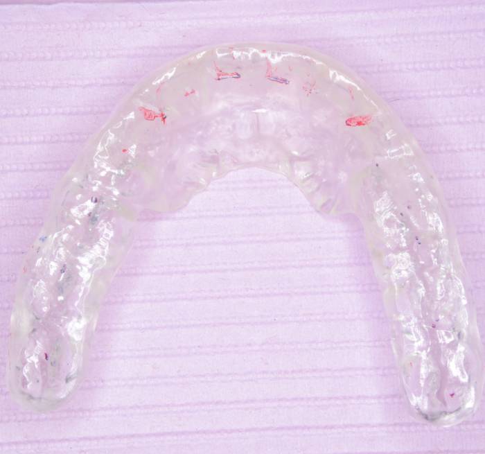 顎関節症の診断と治療