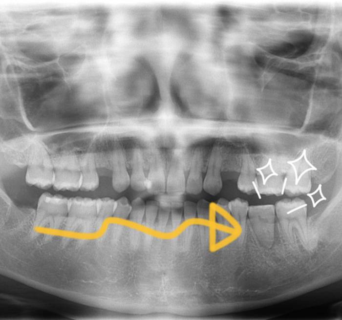 歯の移植（自家歯牙移植）