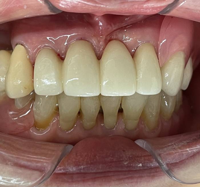 見た目も自然な「バネのない入れ歯（エステデンチャー）」